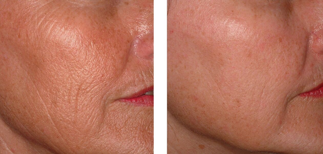 The renewal of the skin