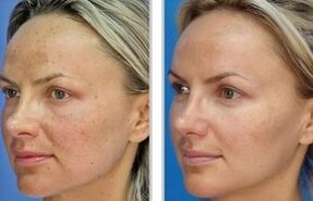 Laser peeling