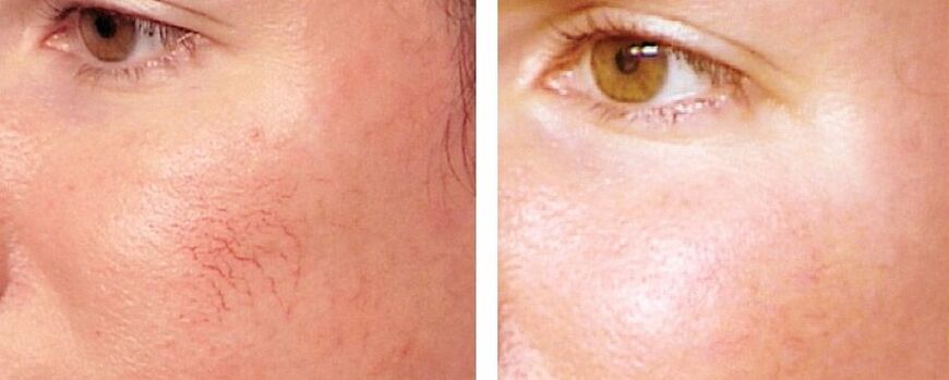 Rosacea removal