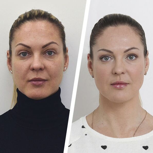 Facial skin rejuvenation before and after without surgery