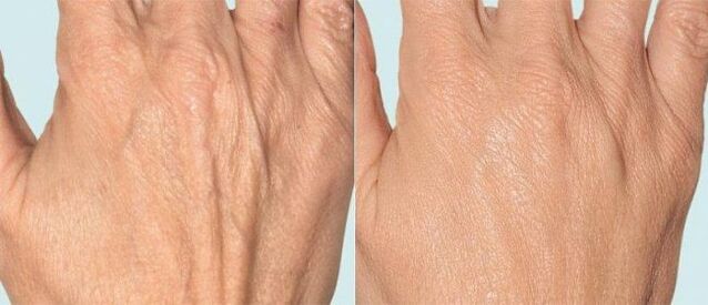 Hand skin before and after fractional therapy