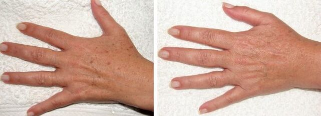 The result of removing pigment spots on the hand