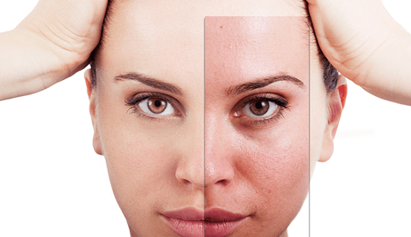 fractional rejuvenation removes the main aesthetic flaws of the face
